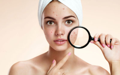 Acne ed esiti di acne: come intervenire per migliorarne l’impatto estetico